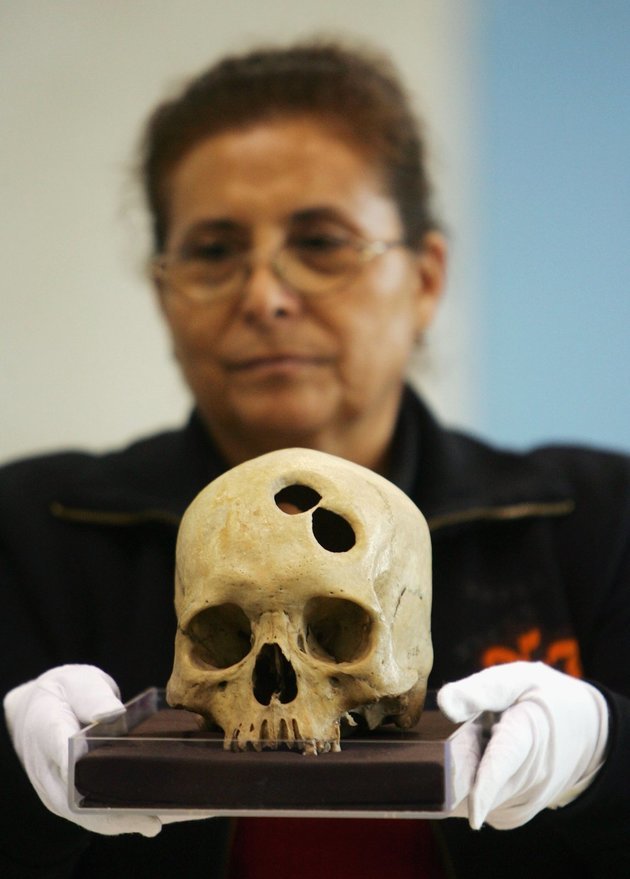 Egy 16. században élt középkorú inka nő trepanált koponyája