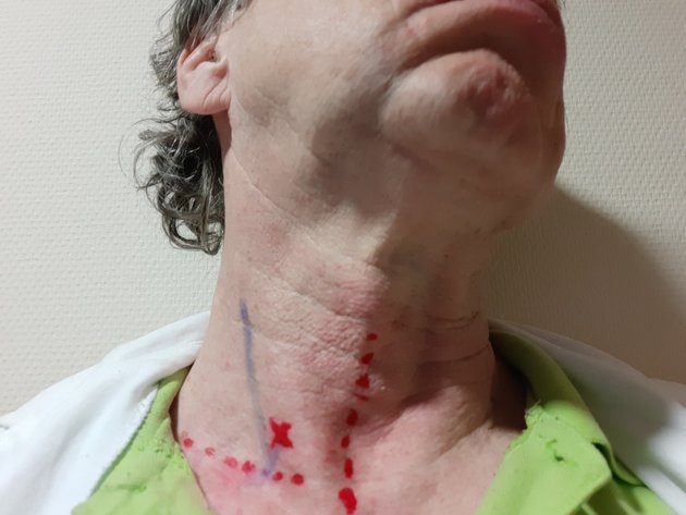 A nyak pozíciója ahhoz, hogy a boncleletben rögzített sérülések keletkezzenek (ép nyaki ütőér, sérült gyüjtőér, a nyakcsigolyába ékelődött lövedék). Az egyes képletek viszonyát nyaki ultrahanggal ellenőriztük.  Kereszt jelzi a bemeneti nyílást. A nyaki gyűjtőeret (vena jugularis) kék vonal mutatja