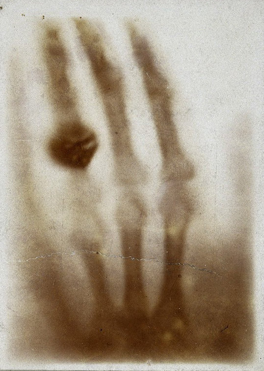 Az egyik első orvosi röntgenfelvétel Anna Bertha Ludwig kezéről készült
