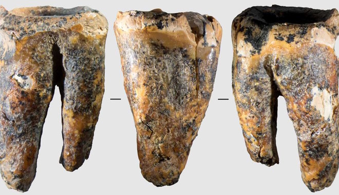 Már a neandervölgyi fogorvosok is használtak fúrót